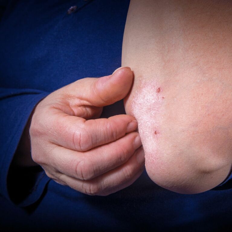 Psoríase e Dermatites